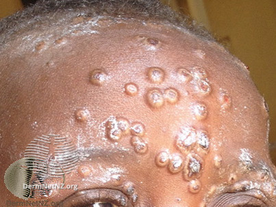 Cacar Monyet (Monkeypox)